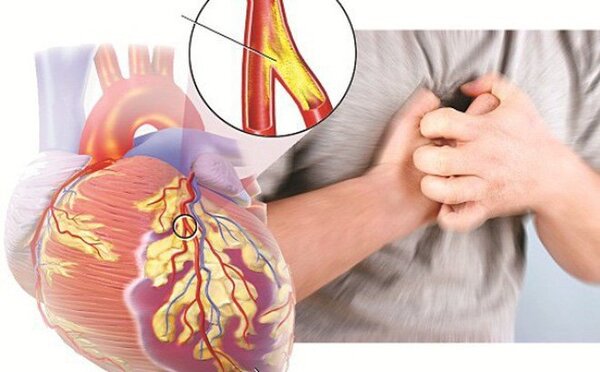Suy tim là gì? Những triệu chứng của suy tim
